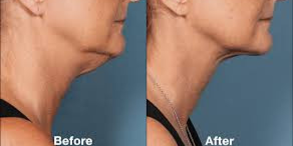 Kybella Injections in Torrance, CA: The Non-Surgical Solution for Double Chin Reduction